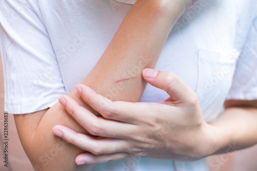 Close up of brown lesion from iron. Lesion burn from iron.