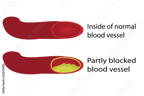 Healthy and blocked blood vessels illustration