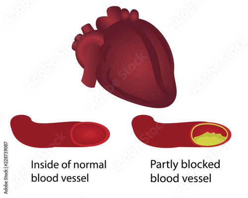 Healthy and blocked blood vessels illustration