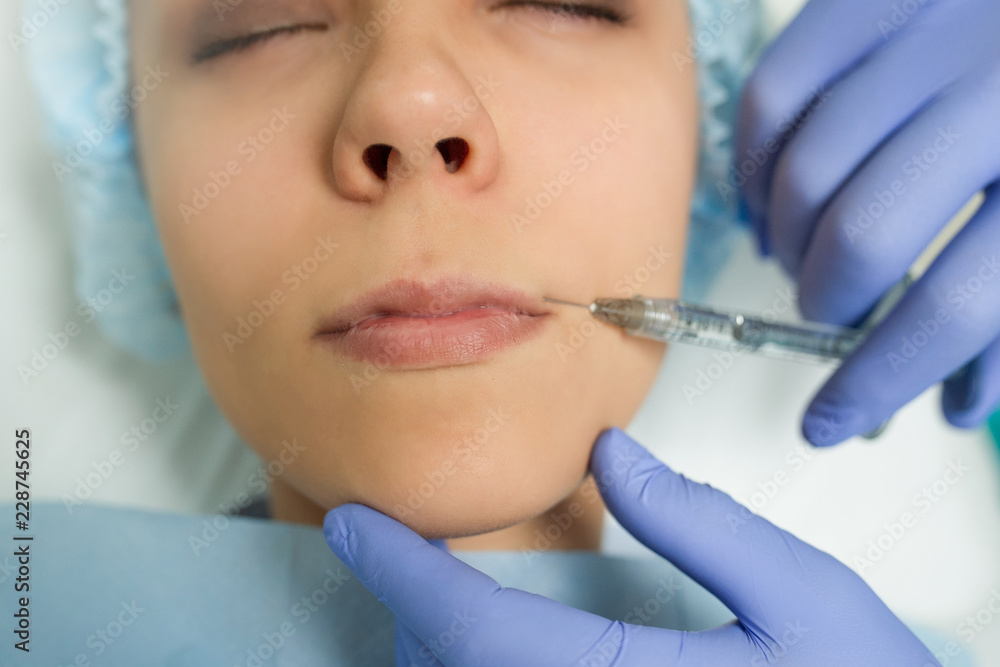 Top view of lips augmentation procedure on a young woman done by a cosmetologist doctor with Hyaluronic acid Injection.
