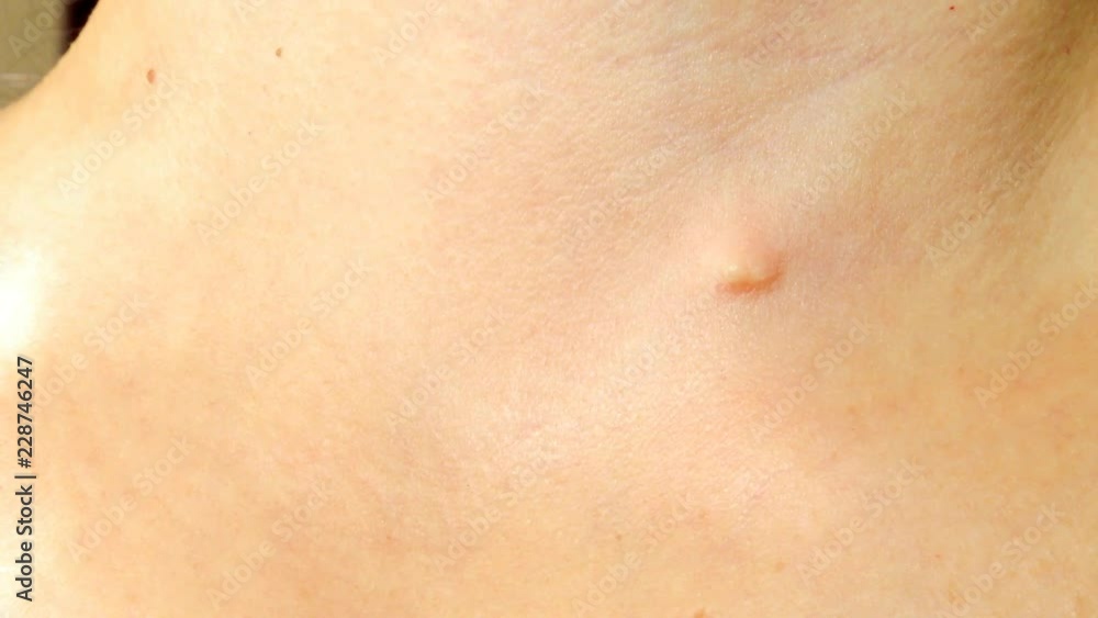Defect on the skin, pinch Defect on the skin, pinch