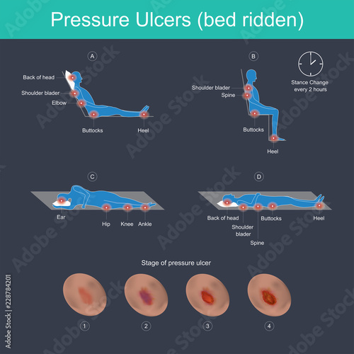 Pressure Ulcers (bed ridden).
The Blood vessels in the human body are responsible for transporting corpuscle to the organ and throughout the body, These blood vessels have different sizes. photo