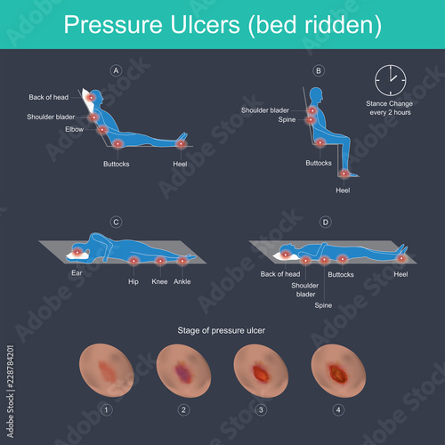 Pressure Ulcers (bed ridden).
The Blood vessels in the human body are responsible for transporting corpuscle to the organ and throughout the body, These blood vessels have different sizes.