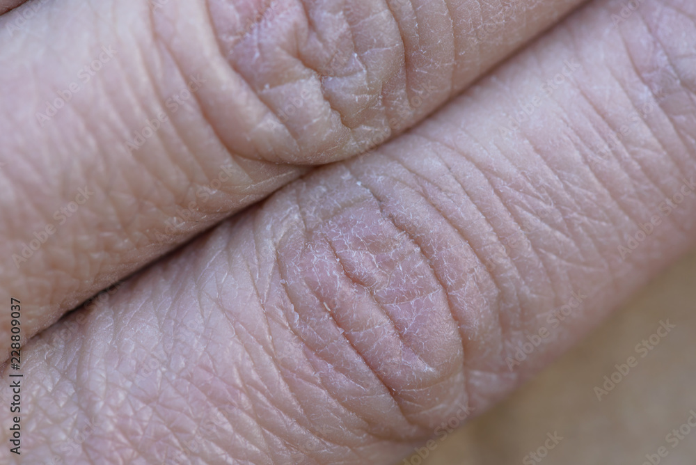 The problem with many people - eczema on hand. The problem with many people - eczema on hand.
