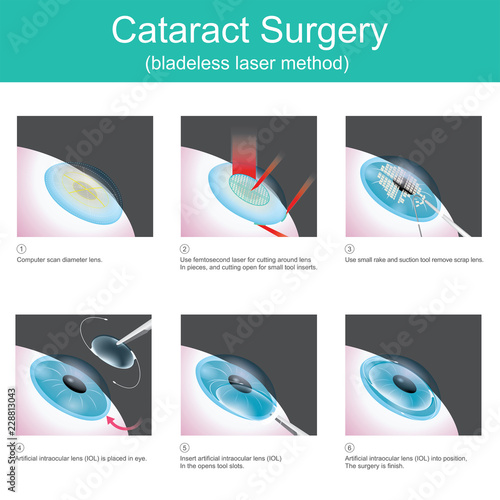 Cataract Surgery. The use of medical lasers to cutting eye lens in small pieces and suction out, in order to use artificial lenses, because the symptoms are cataracts. 