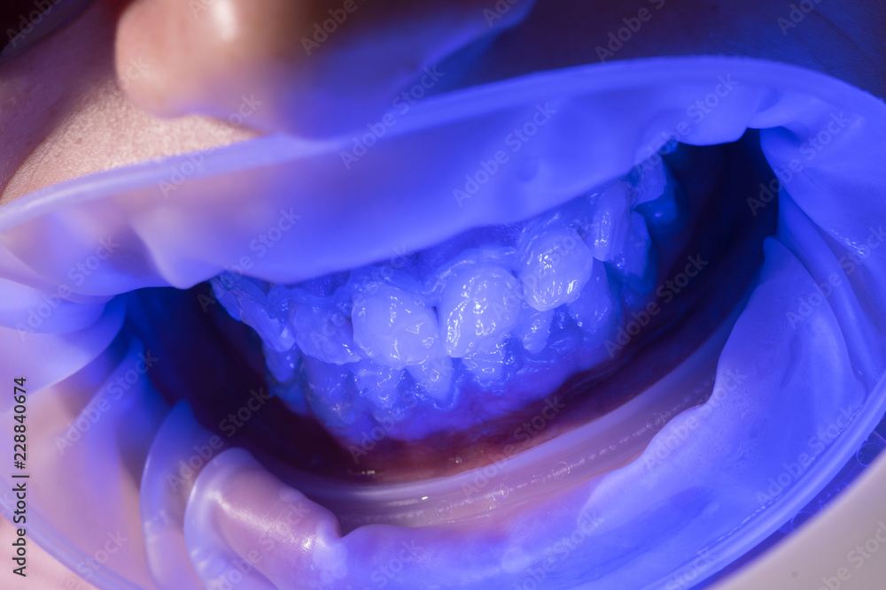 Foto de UV Whitening teeth. Administer anesthetics to keep patients