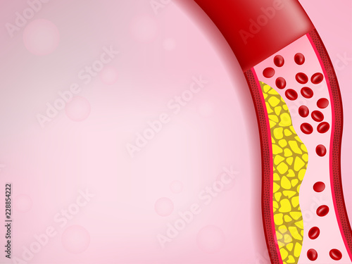 Cholesterol in artery