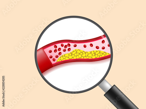 Magnifying glass is watching the vein with cholesterol