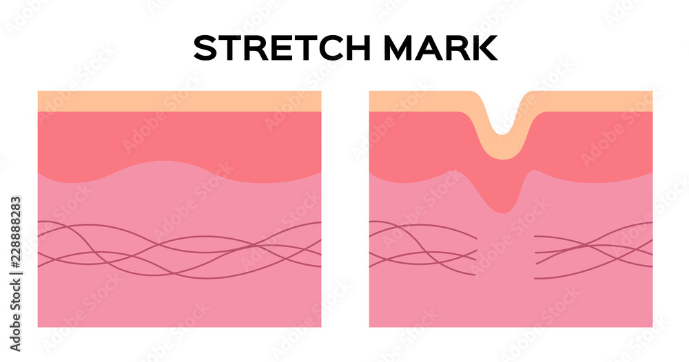 stretch mark and collagen vector