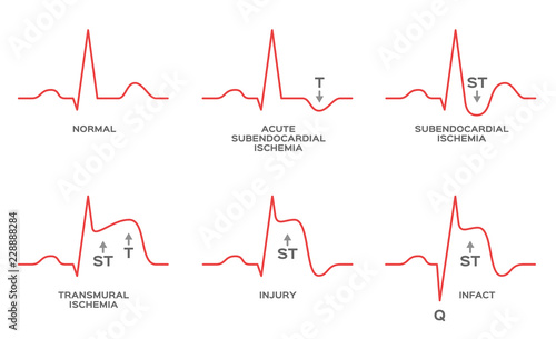 diagnosis myocardial ischemia vector / NSTEMI, STEMI photo