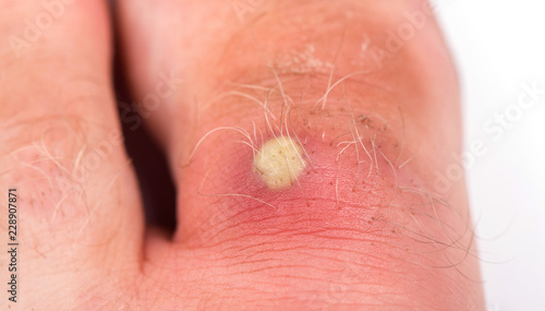 Photos purulent pimple on toe