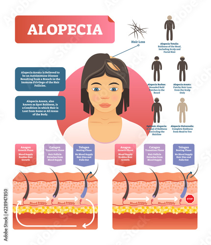 Alopecia - hair loss autoimmune disease medical vector diagram illustration