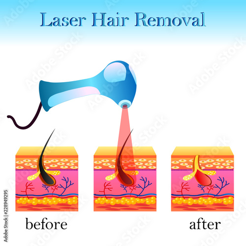 laser hair removal, structure of the cell and a laser apparatus