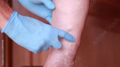 Varicose veins examination on woman's leg