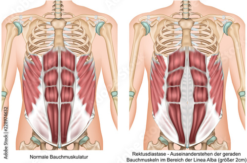 Rektusdiastase Anatomie Bauchmuskeln vektor illustration