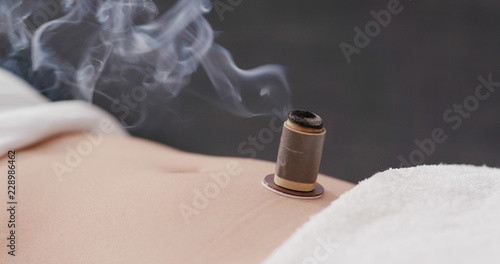 Chinese traditional medicine moxibustion therapy photo
