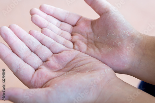 close up boy's hand skin peeling due