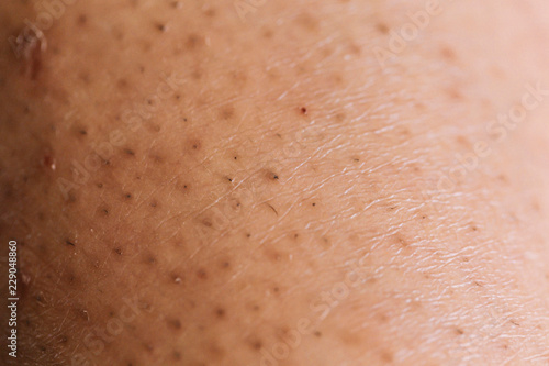 Closeup of caucasian skin with ingrown hair
 photo