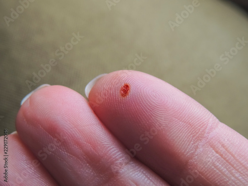 Wound after removing the wart on the finger. © Irina