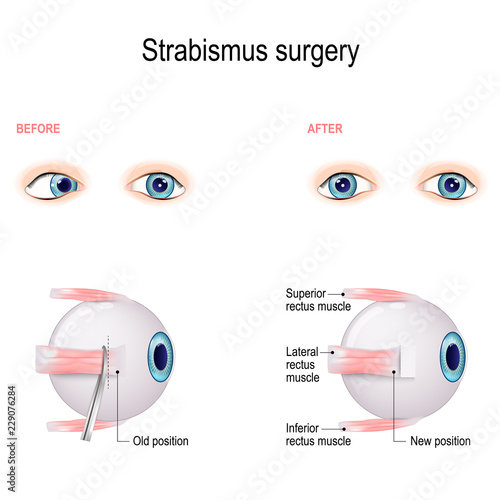 Strabismus Surgery. Eye muscle recession