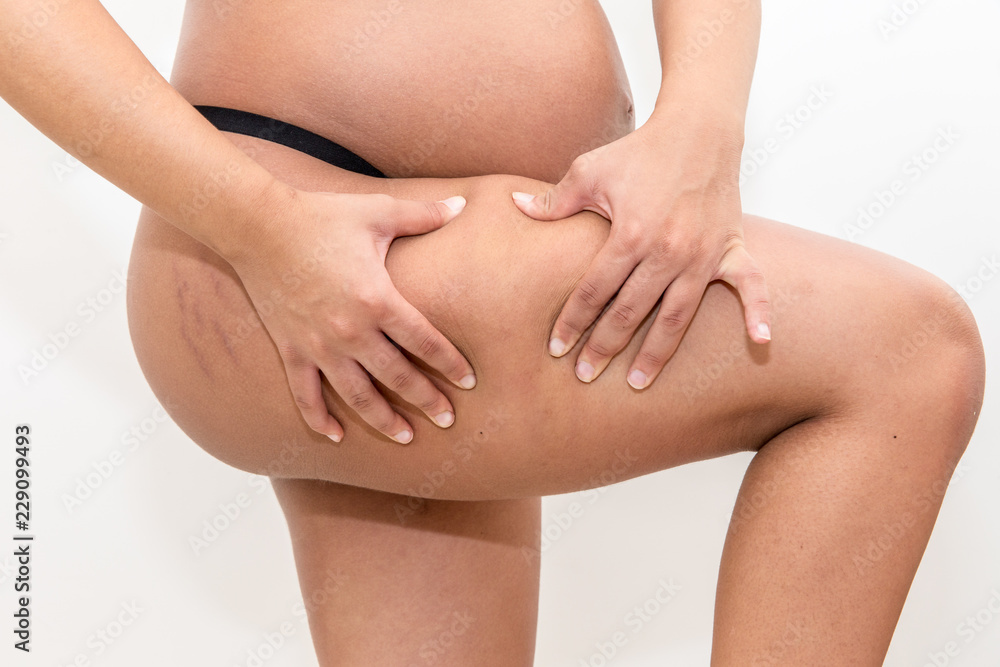 Closeup of a pregnant woman with stretch marks. Closeup of a pregnant woman with stretch marks.