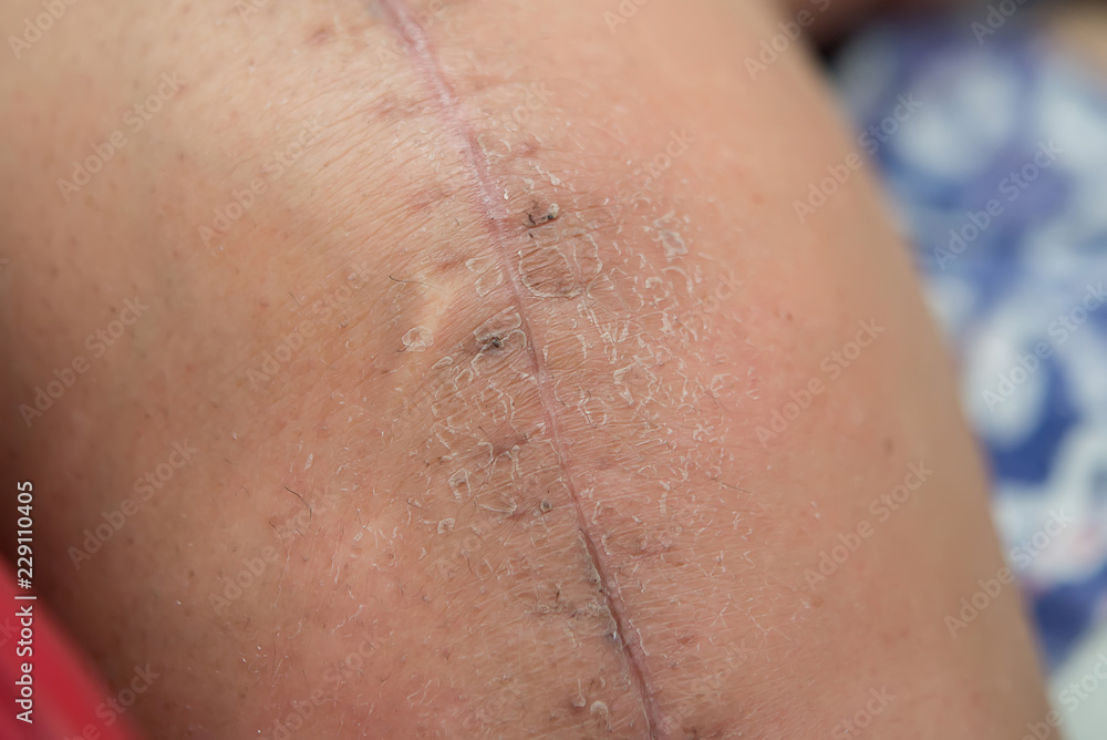 Fototapeta premium woman patient show her scar