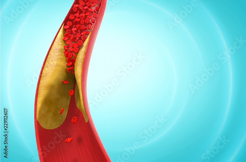 blood cells with plaque buildup of cholesterol 3d Illustration. photo