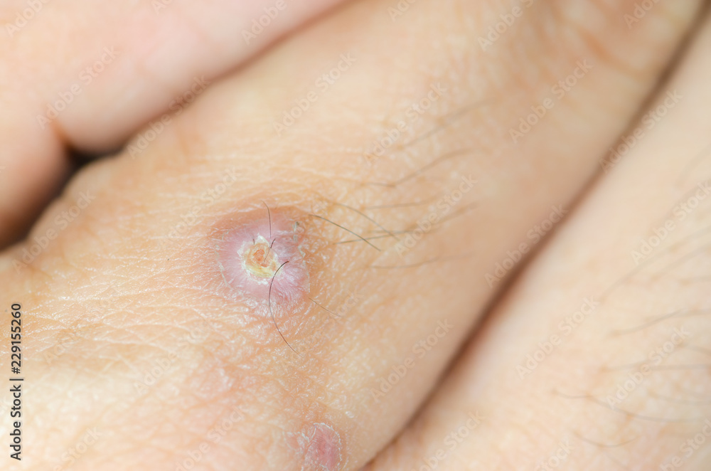 Abscess on man hand,select focus Abscess on man hand,select focus