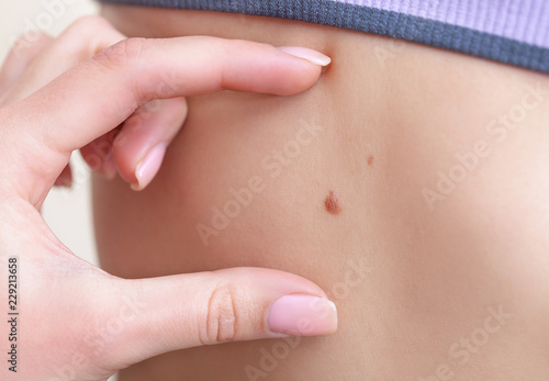 Doctor's hands checking moles on patient skin.