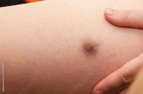 A bright injury injures the thigh of a young woman. The concept of pain close-up. Hematoma on the leg.