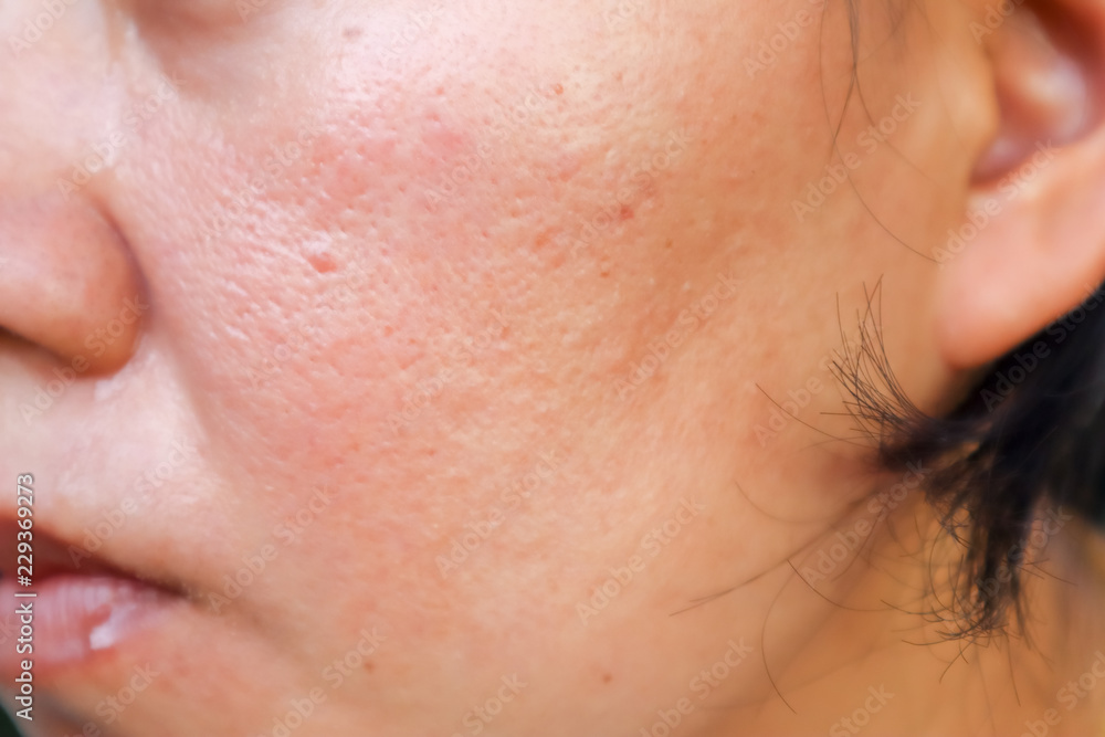 Obraz premium Scar from Acne on face.