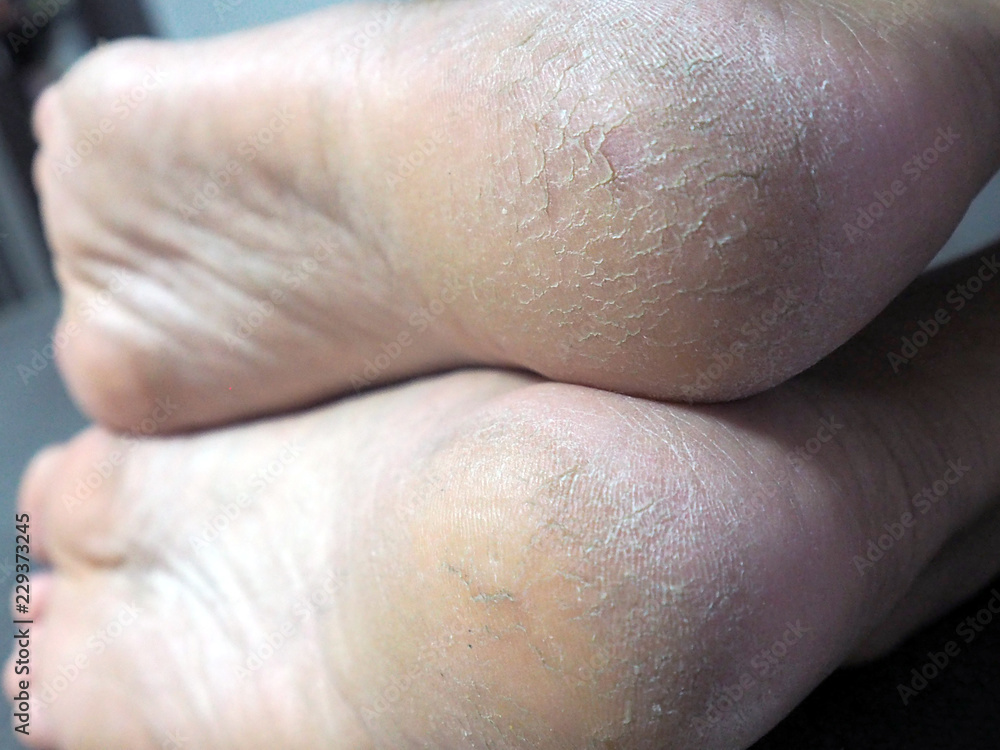 Fototapeta premium Heel break close up.