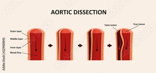 Aortic Dissection, Aortic Aneurysm