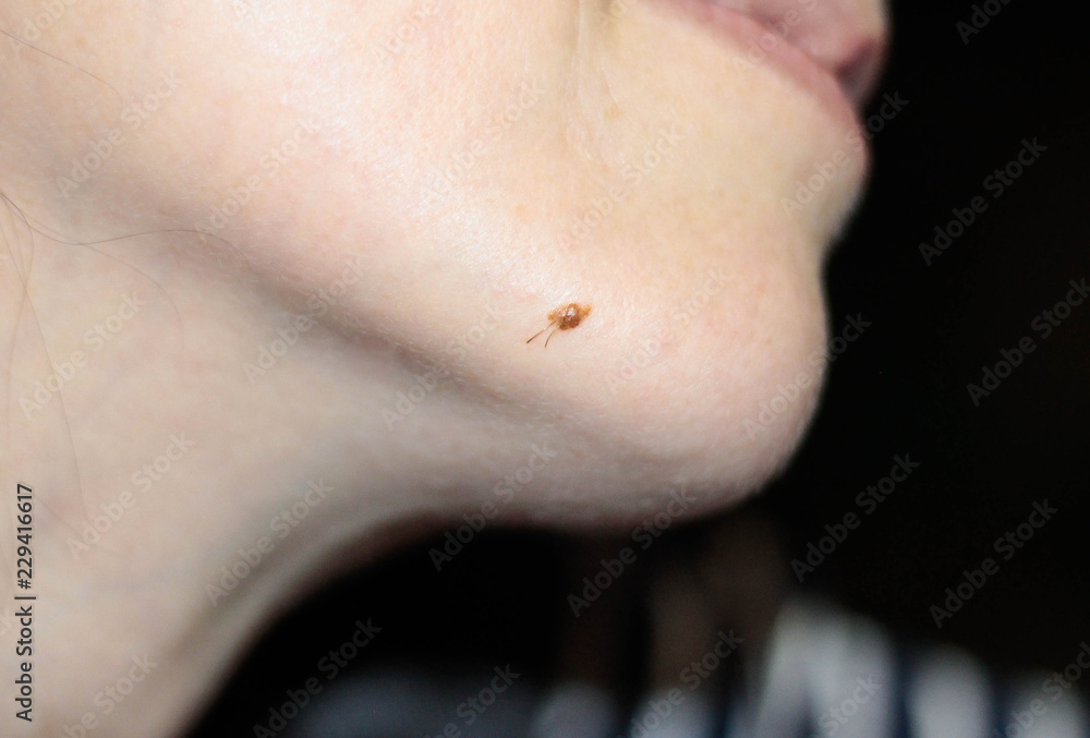 Naklejka premium birthmark on the face with growing out of her hair