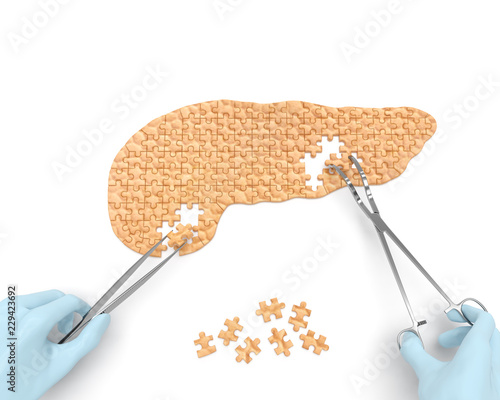 Pancreas puzzle concept: hands of surgeon with surgical instruments (tools) perform pancreas surgery as a result of acute or chronic pancreatitis, pancreatic diabetes, pancreatic cancer photo