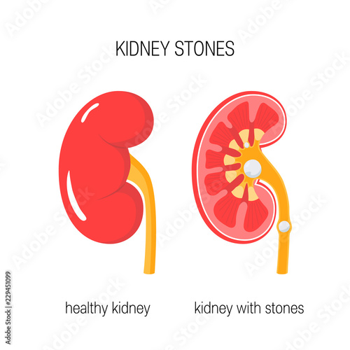 Kidney with stones vector photo