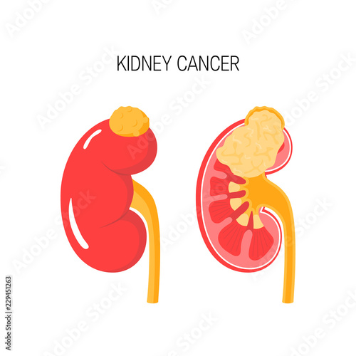 Kidney cancer vector concept