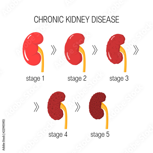 Chronic kidney disease vector