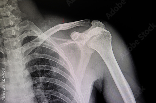 Canvas Print Xray film of a patient with hairline fracture of clavicle.