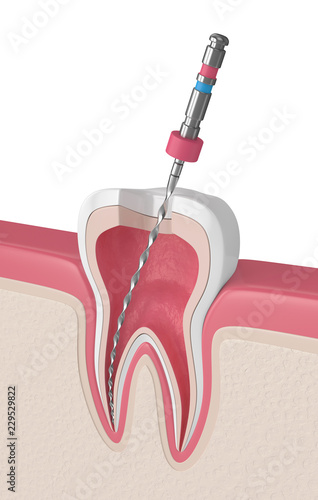 3d render of tooth with endodontic file in gums photo