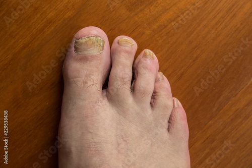 onychomycosis with fungal nail infection two feet photo