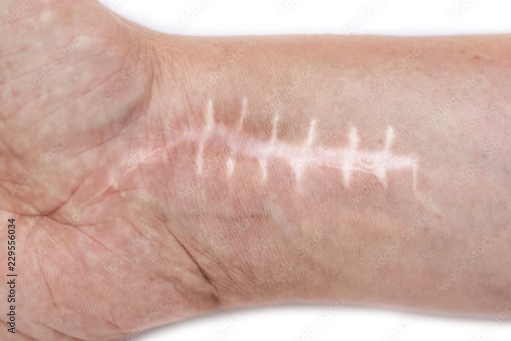 Scar with stitches on the wrist after surgery. Fracture of the bones of ...