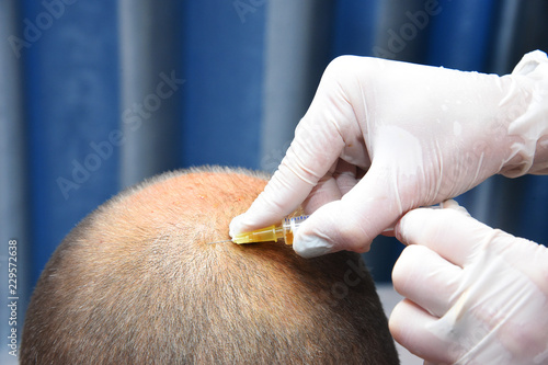 Treatment of baldness with beauty injections. Mesotherapy. Plasmalifting. photo