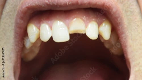 Broken tooth. Broken upper incisor in a man mouth. Man shows oral cavity to the dentist. Treatment of a broken tooth.