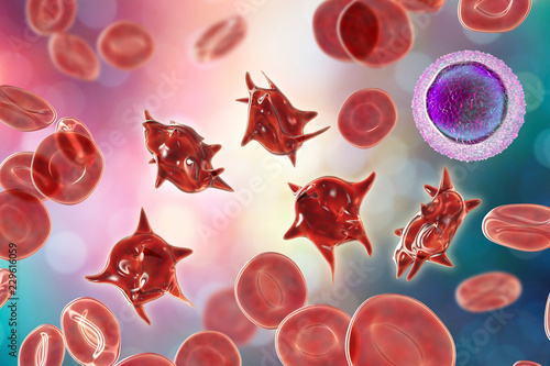 Acanthocytes, abnormal red blood cells with thorn-like projections, 3D illustration. They appear in severe liver disease, vitamin E defficiency, splenectomy, malabsorption, hypothyroidism photo