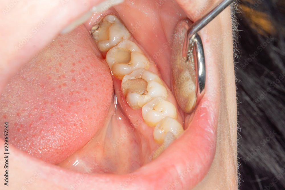 Obraz premium Dental caries. Filling with dental composite photopolymer material using rabbders. The concept of dental treatment in a dental clinic