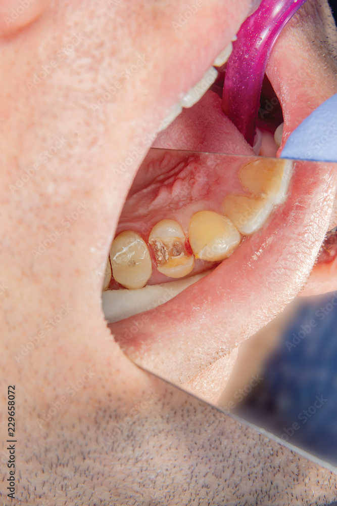 Obraz premium Dental caries. Filling with dental composite photopolymer material using rabbders. The concept of dental treatment in a dental clinic