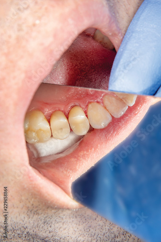 Dental caries. Filling with dental composite photopolymer material using rabbders. The concept of dental treatment in a dental clinic