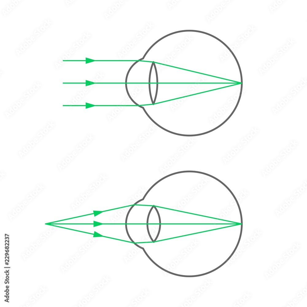 The far and near point of accommodation of an eye with normal vision The far and near point of accommodation of an eye with normal vision