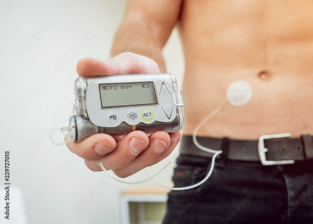 Diabetic man with an insulin pump connected in his abdomen and holding the insulin pump at his hands.